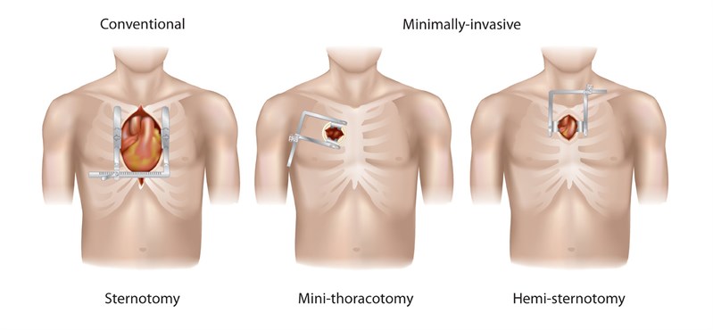 Cardiac Surgery - Minimally Invasive Aortic Valve Surgery